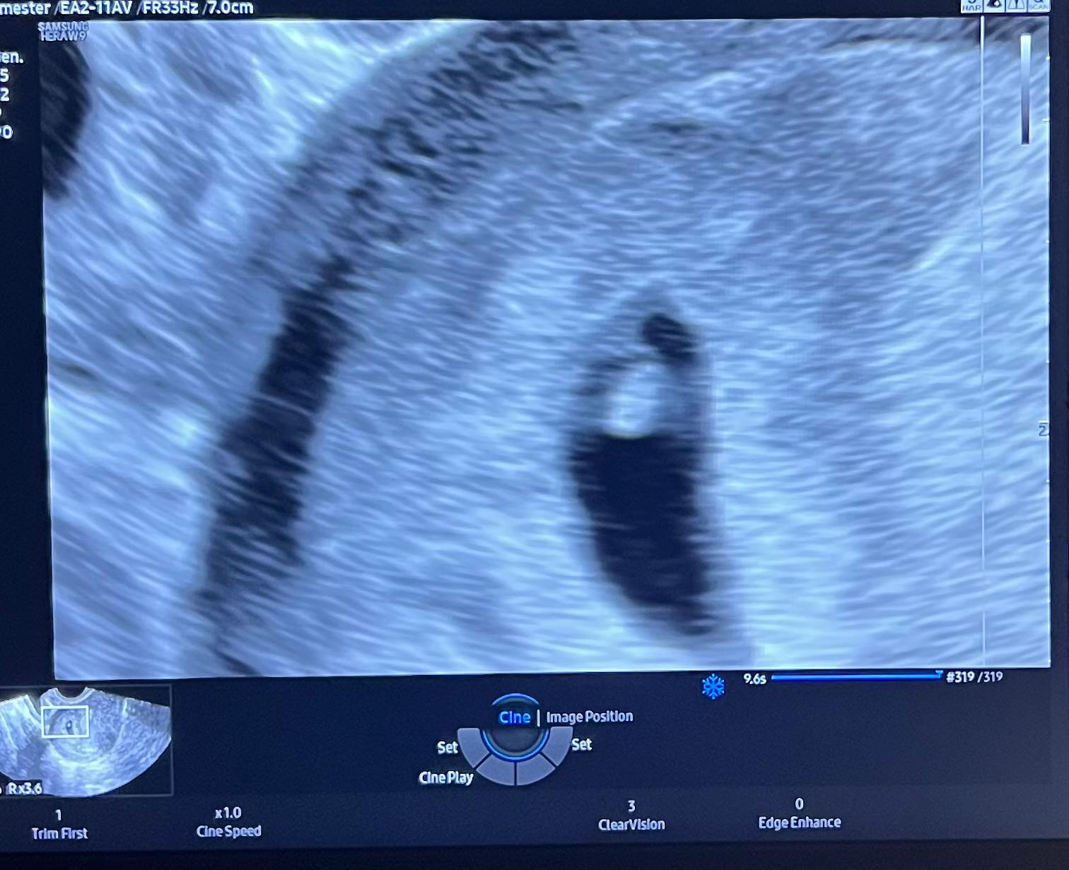 Our baby's first ultrasound scan
